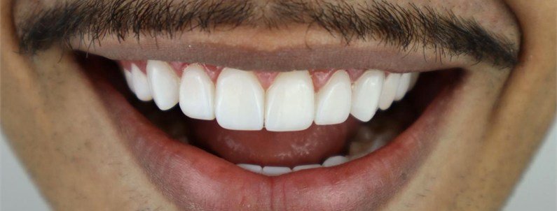 Depois de lentes em resina