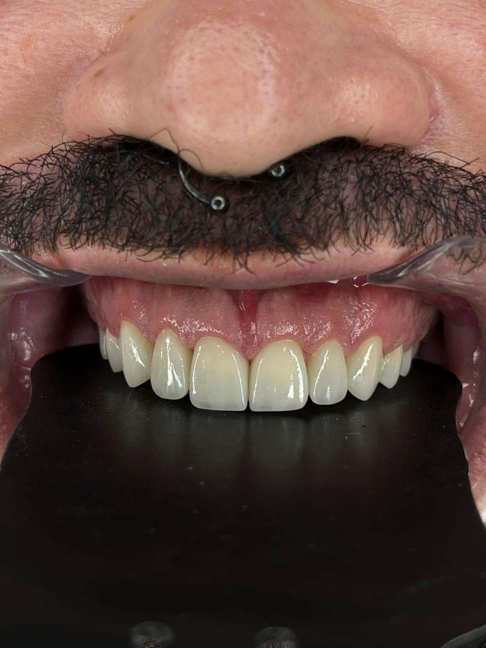 Depois de lentes em resina do caso masculino clínico