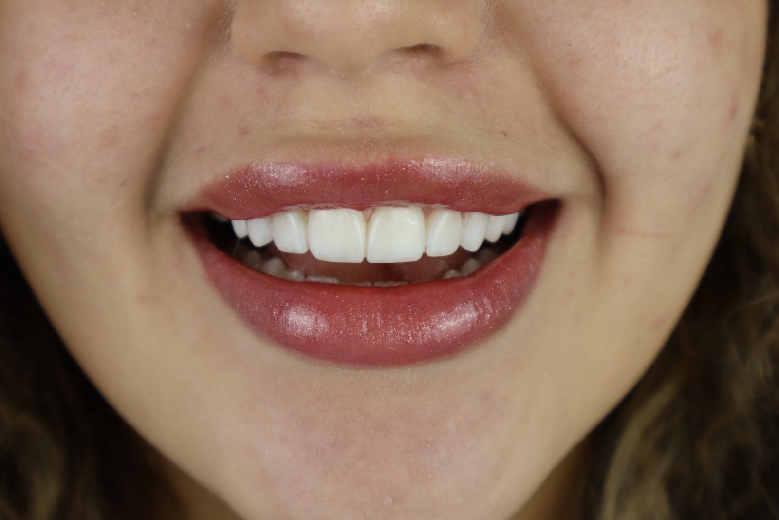 Caso de estética dental do portfólio