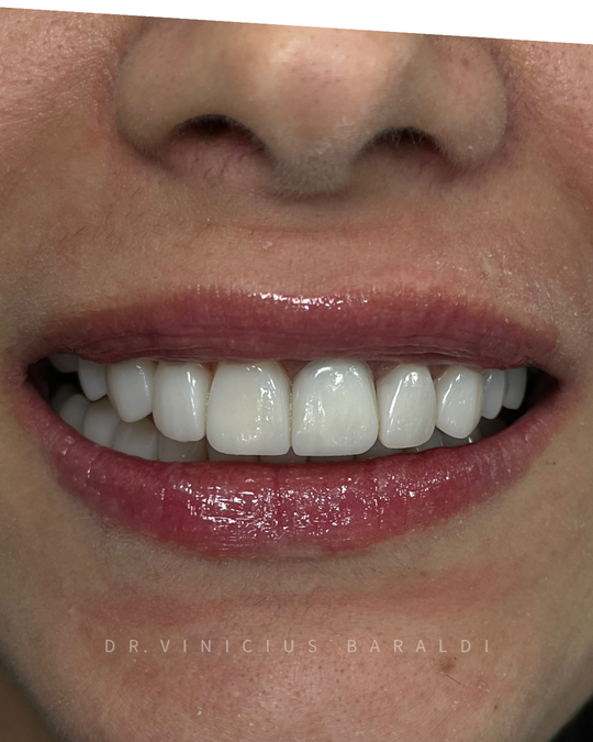 Depois de tratamento estético dental