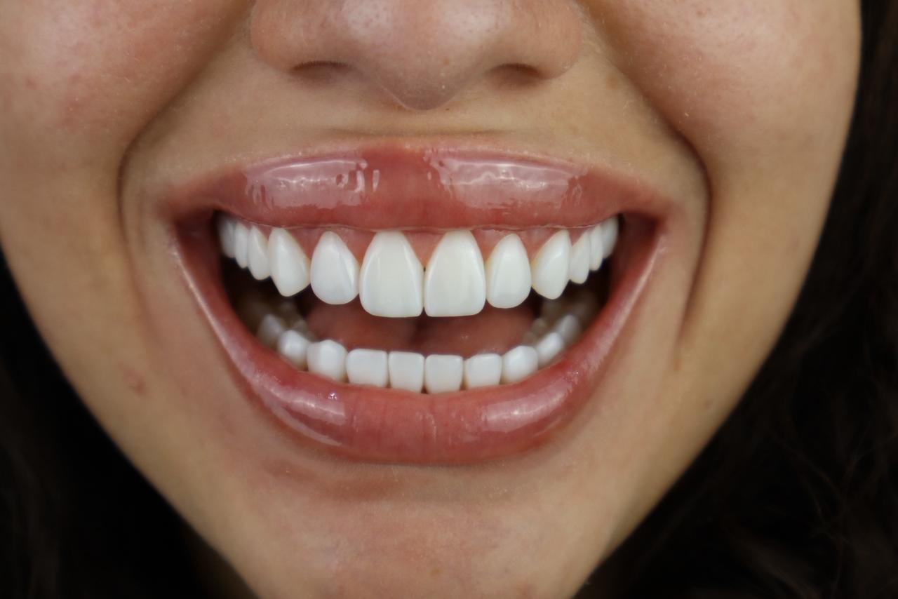 Resultado estético com sorriso amplo e harmônico
