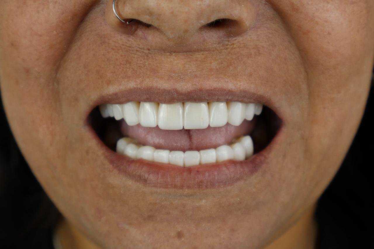 Caso de reabilitação estética do sorriso