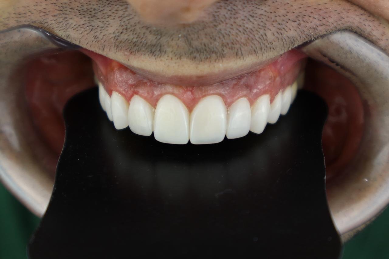 Sorriso masculino com lentes em resina